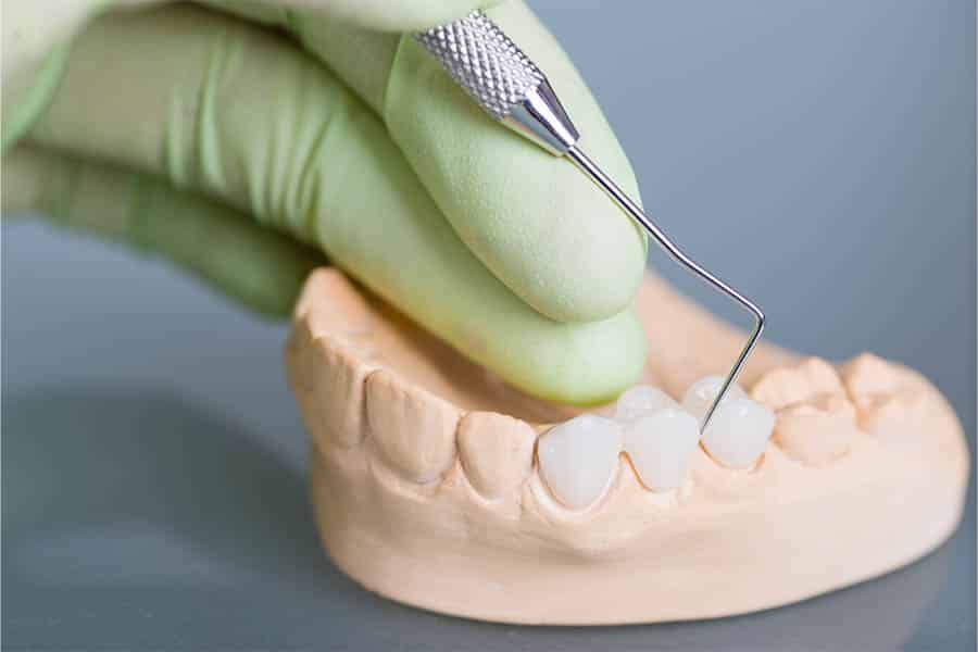 Emax Crowns treatment in North Fort Myers