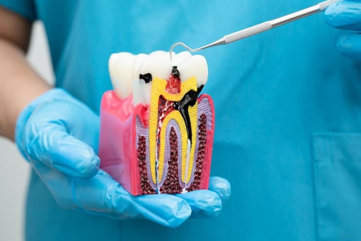 Root Canals treatment in North Fort Myers